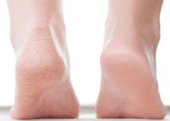 फटी एड़ियां ठीक करने के लिए अपनायें ये बहुत ही आसान तरीके