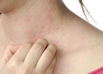 त्वचा रोग से रहें सावधान, इन घरेलू उपायों को करें ट्राई