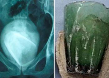 चार साल से महिला के प्राइवेट पार्ट में हो रहा था दर्द, सर्जरी में निकली हैरान करने वाली चीज