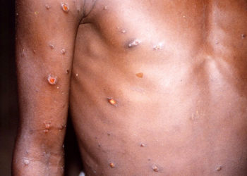 कोरोना के बाद यूरोप में मंकीपॉक्स की आहट, UK, पुर्तगाल और स्पेन में मामले सामने आए