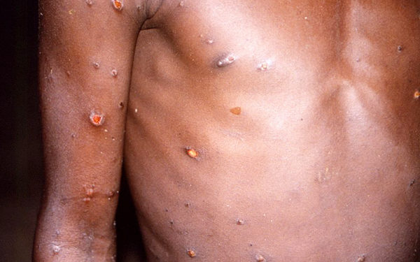 कोरोना के बाद यूरोप में मंकीपॉक्स की आहट, UK, पुर्तगाल और स्पेन में मामले सामने आए