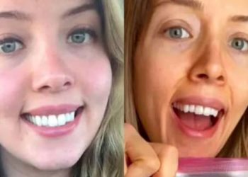 कद्दू और शकरकंद खाकर महिला ने कम किया वजन, लेकिन हो गया ये नुकसान