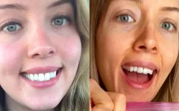 कद्दू और शकरकंद खाकर महिला ने कम किया वजन, लेकिन हो गया ये नुकसान