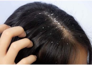 अगर आप भी हैं डैंड्रफ से परेशान तो एक बार जरुर ट्राई करें ये टिप्स