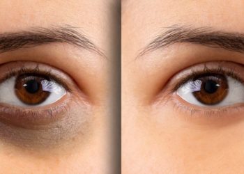 Dark Circle Remedies: इन घरेलू उपायों से गायब होंगे आंखों के काले घेरे