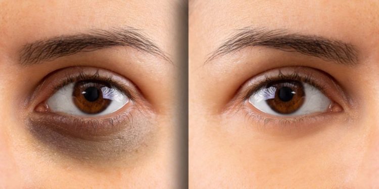 Dark Circle Remedies: इन घरेलू उपायों से गायब होंगे आंखों के काले घेरे