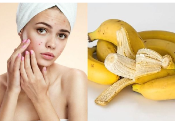 केले से चेहरे के सभी मुंहासे हो जाएंगे खत्‍म, ये है इस्तेमाल का तरीका