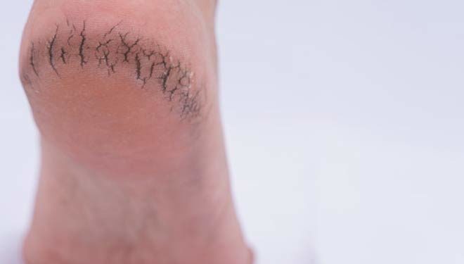 फटी एड़ियां ठीक करने के लिए अपनायें ये आसान और घरेलू तरीके  