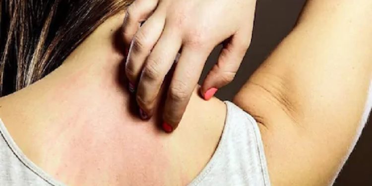 इन छोटे-छोटे उपायों से दूर होगी रूखी त्वचा से खुजली