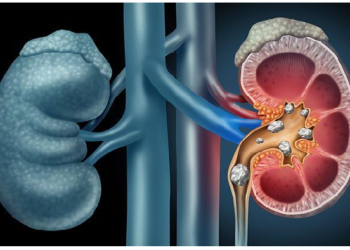कई वजहों से हो सकता है किडनी स्टोन, इन तरीकों को अपना लें नहीं होगी समस्या