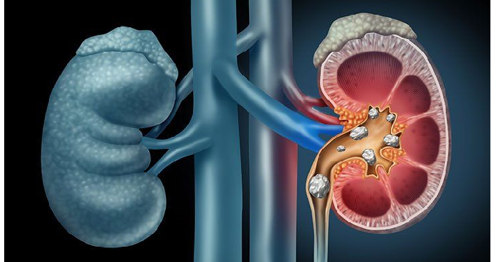 कई वजहों से हो सकता है किडनी स्टोन, इन तरीकों को अपना लें नहीं होगी समस्या