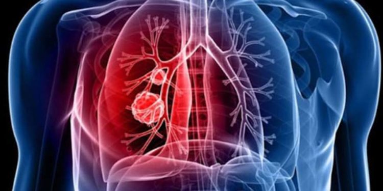 क्यों बढ़ रही है फेफड़ें की बीमारी के रोगियों की तादाद बढ़ रही