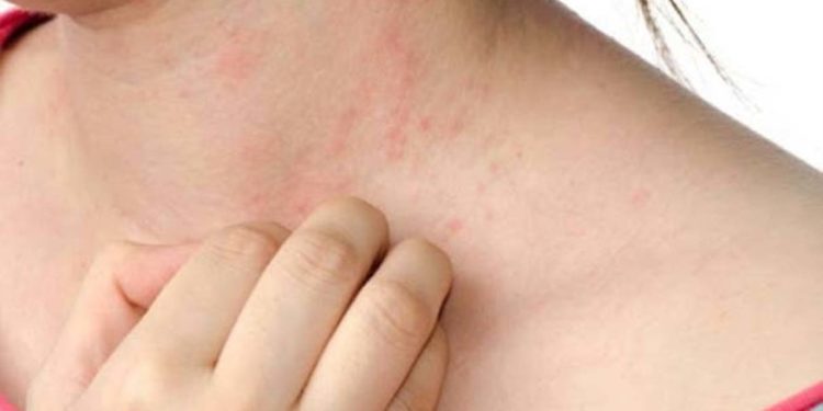 गर्मी में चर्म रोगों से ऐसे करें बचाव