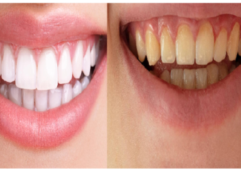 अगर आप है दांतों के पीलेपन से परेशान हैं तो ऐसे मिलेगी सफेदी की चमकार