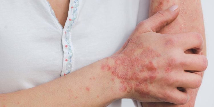 चर्मरोगों को इस प्रकार रखें दूर 