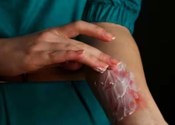 जलने पर अपनायें ये घरेलू उपाय, तुंरत पहुंचेगा फायदा