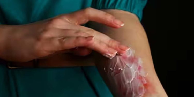 जलने पर अपनायें ये घरेलू उपाय, तुंरत पहुंचेगा फायदा