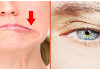 बोटोक्स टीके के साइड इफेक्ट, झुर्रियां रोकने के तरीके से 80 फ़ीसदी पैनिक अटैक के शिकार