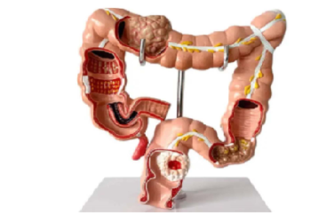 शख्स की आंत में मिली ज़िंदा मक्खी, ‎चि‎कित्सकों ने जताई हैरानी