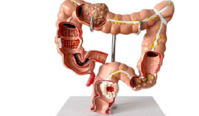 शख्स की आंत में मिली ज़िंदा मक्खी, ‎चि‎कित्सकों ने जताई हैरानी