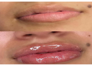 सुंदर दिखने कराई होठों की सर्जरी, हो गया कैंसर जानिए कैसे?