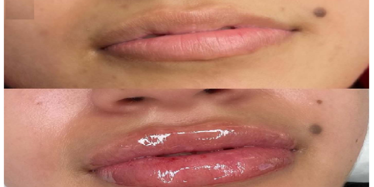 सुंदर दिखने कराई होठों की सर्जरी, हो गया कैंसर जानिए कैसे?