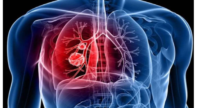 फेफड़ें की बीमारी के रोगियों की तादाद बढ़ रही