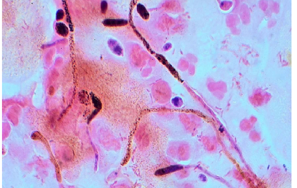 अमेरिका में फैल रहा कैंडिडा ऑरिस नामक बेहद घातक संक्रमण, मचा हड़कंप