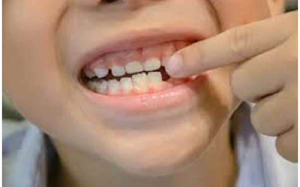 बच्चे के दूध के दाँतों की देखभाल जरुरी