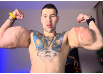 मशल्स बनाने की सनक में बांहों में भर लिया 6 लीटर वैसलिन, बांहें फुलकर हो गईं गुब्बारे की तरह