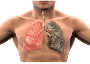 फेफड़ों का कैंसर और उसके लक्षण