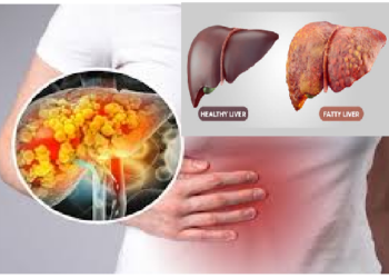 ये फूड्स बढ़ाते हैं फैटी लिवर का खतरा, रोज खाना सेहत के लिए खतरनाक