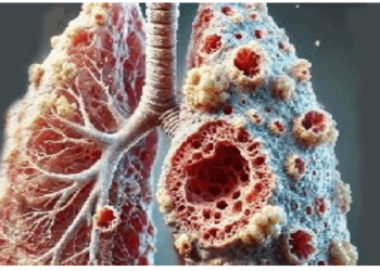 17 साल की चीयरलीडर पॉपकॉर्न लंग्स से पीड़ित, क्या होती है ये बीमारी