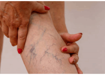 जांघों के आसपास उभरने वाली नीली नसें हो सकती है वैरिकोज़ वेन्स का संकेत