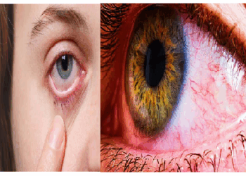 आंखों में जलन, पानी आना, लालिमा जैसे लक्षणों को ना करें नजरअंदाज