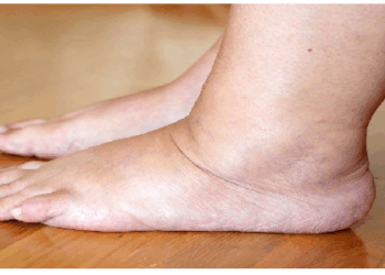 पैरों में सूजन की सबसे आम वजह ‘फ्लूड रिटेंशन’