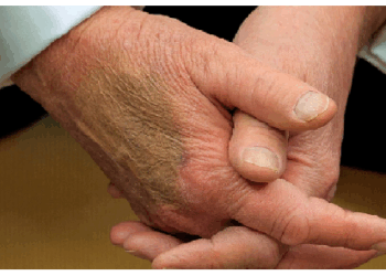 ट्रंप की नसें पड़ने लगीं काली, ये बीमारी कैसे होती है और कितनी खतरनाक है