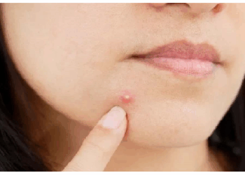 मुंहासों को ठीक करने करें ये उपाय