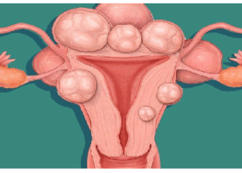 अधिक वजन की महिलाओं को फायब्रॉइड का खतरा