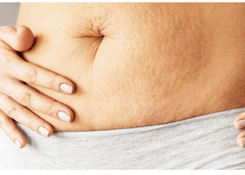 स्ट्रेच मार्क्स से छुटकारा पाने करें घरेलू उपाय