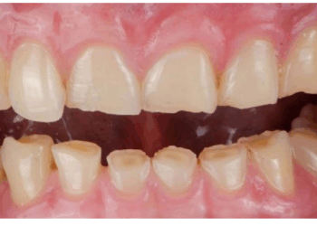 दांतों की सफाई के लिए नीम, पुदीना और अमरूद की पत्ती बेहद कारगर