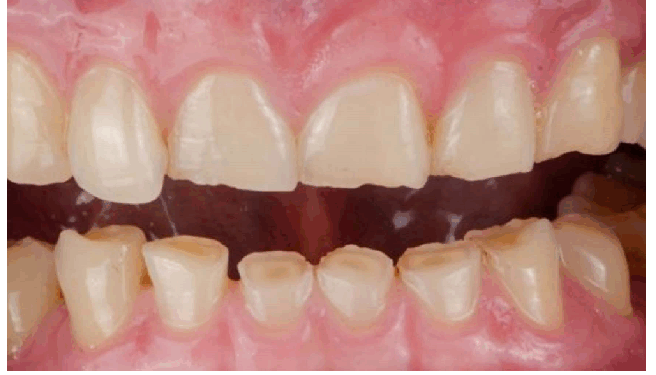 दांतों की सफाई के लिए नीम, पुदीना और अमरूद की पत्ती बेहद कारगर