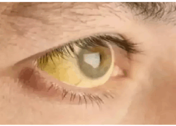 ब्लड कैंसर का संकेत भी हो सकता है आंखों का पीला पड़ना