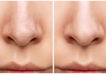 इन आसान तरीकों से ब्लैकहेड्स मिनटों में होंगे दूर