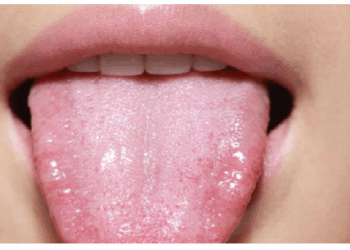 जीभ शरीर की सेहत का होती है आईना