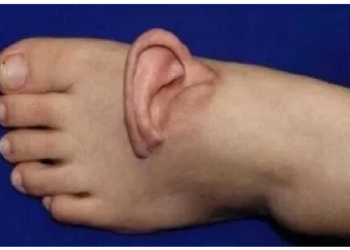 डॉक्टरों का कारनामा, पहले पैर पर कान लगाया, फिर लगा दिया सिर पर