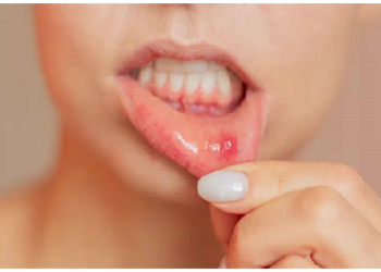 मुंह के छाले: मामूली समस्या नहीं, शरीर के अंदरूनी असंतुलन का संकेत