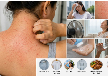 गर्मी में घमौरियों की समस्या को ना करें नजरंदाज: विशेषज्ञ
